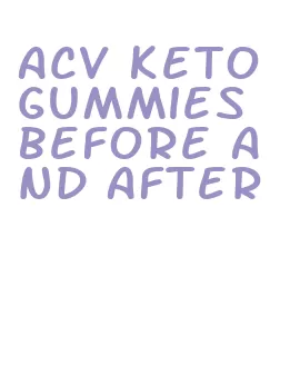 acv keto gummies before and after